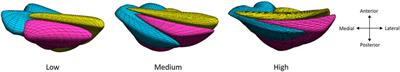 Achilles tendon compliance influences tendon loading more than Achilles tendon twist in Achilles tendinopathy: a musculoskeletal modeling approach